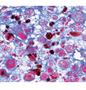 PATOLOGII HISTOLOGICE UMANE